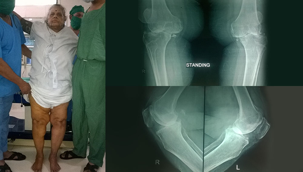 Knee Replacement in vadodara
